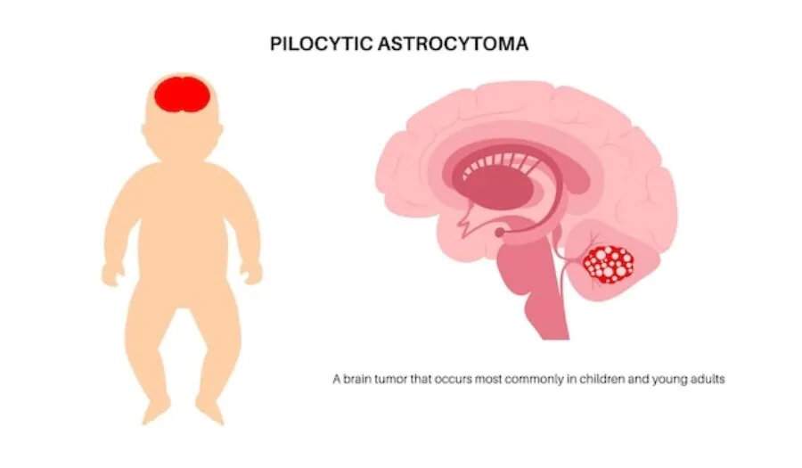 Zaburzenia neurologiczne u niemowląt objawy – jak rozpoznać niepokojące sygnały w rozwoju malucha?